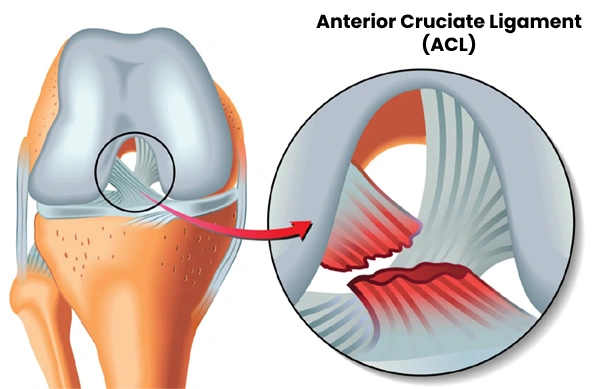 ACL reconstruction surgery in Dubai , UAE