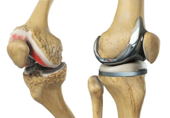 Knee Replacement Surgery in Dubai, UAE | Dr. Azam Badar Khan