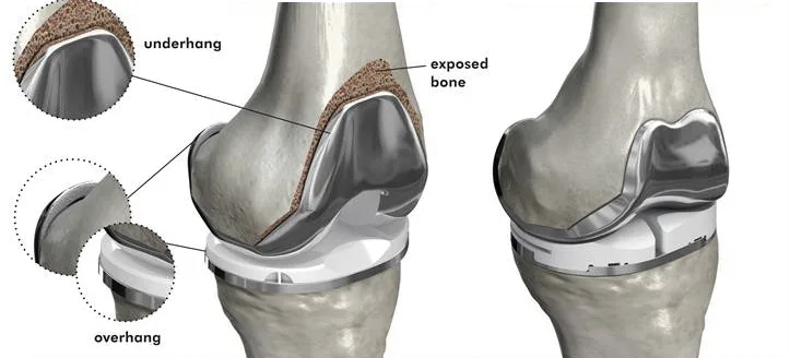 Total Knee Replacement in Dubai -  Dr. Azam Badar Khan