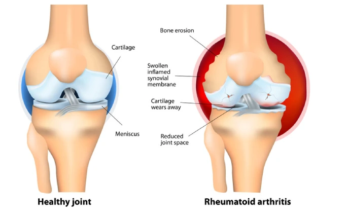 Rheumatoid Arthritis treatment in Dubai, UAE - Dr. Azam Badar Khan