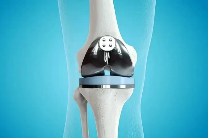  Knee Replacement Surgery in Sharjah